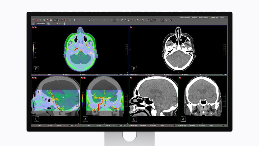 Apple Studio Display XDR viser CT- og MR-bilder av en hjerne i radiologiprogramvaren Visage 7.